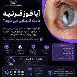 قوز قرنیه و نابینایی ؛ هر آنچه باید بدانید